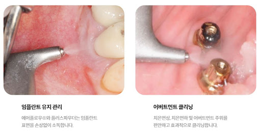 불당본점 서울비디치과의원, 천안 치아교정 전문 서비스로 건강한 웃음을 선사합니다!